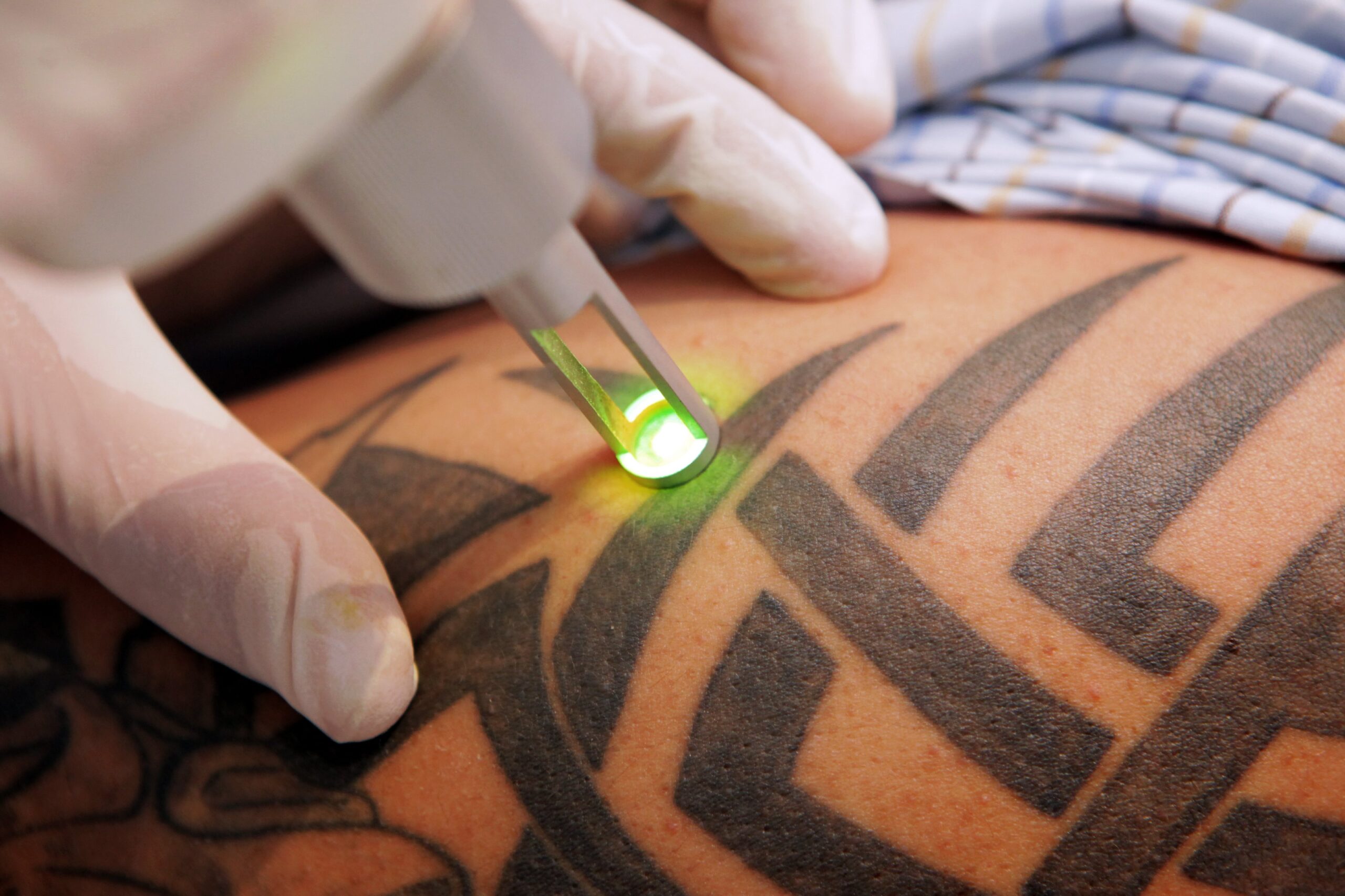 Tattoo Removal Bristol
