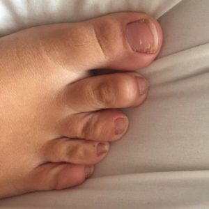 toenail fungal treatment Bristol
