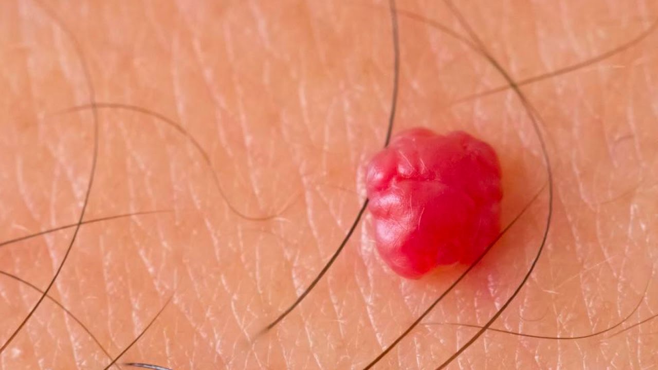 cherry angioma removal Bristol