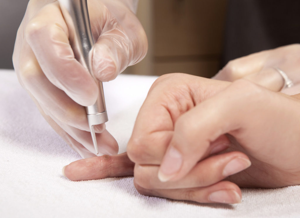 wart removal Bristol