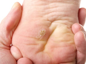 wart removal Bristol