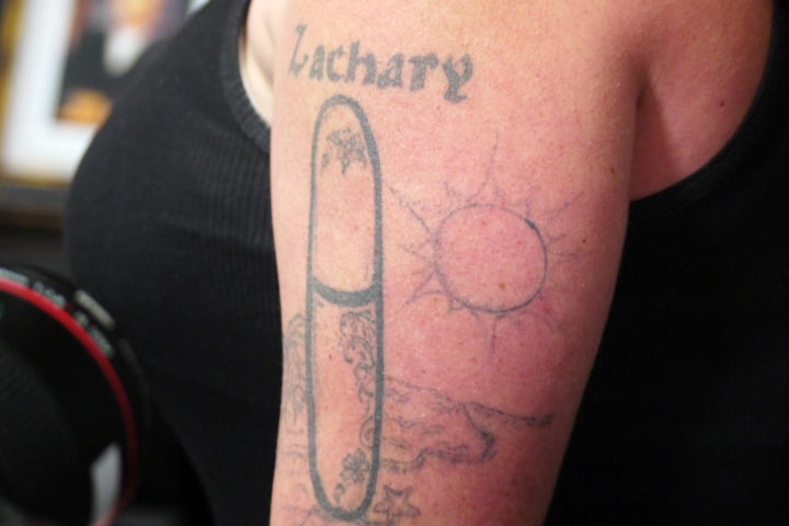 Bristol tattoo removal