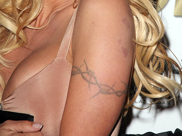 tattoo removal Bristol