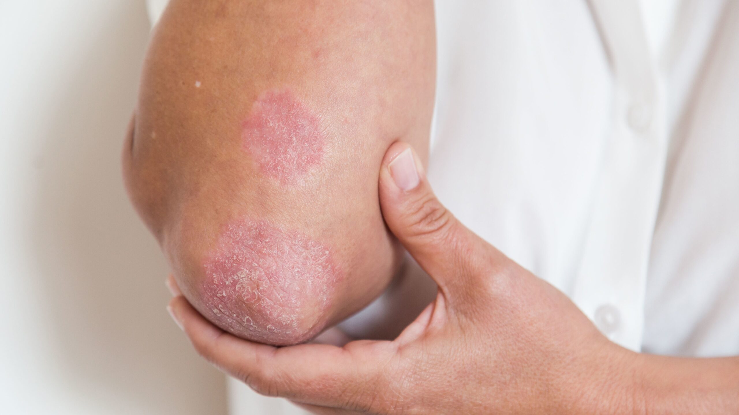 Cryotherapy Eczema Treatment