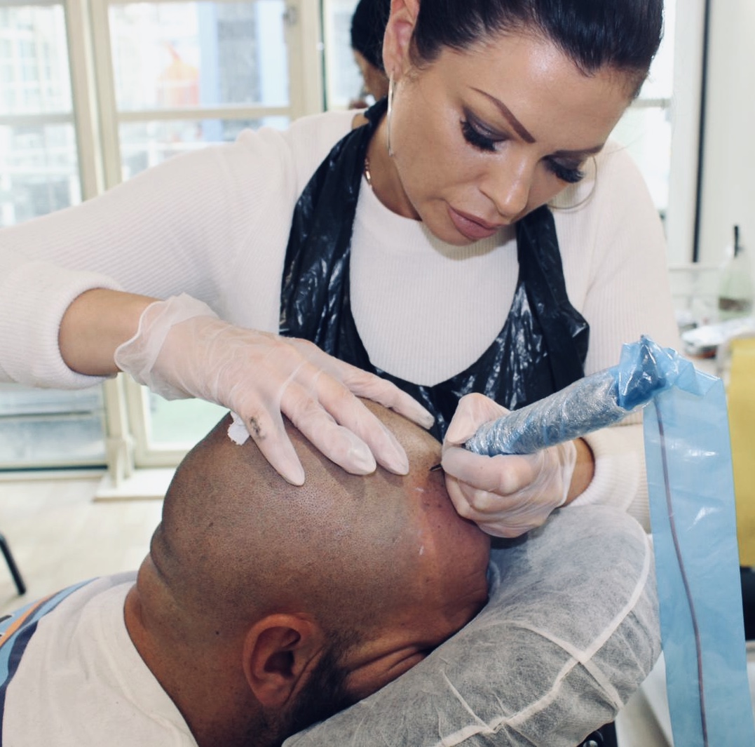 Scalp micro-pigmentation treatment