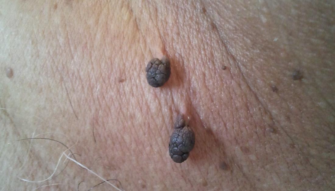 Skin tags
